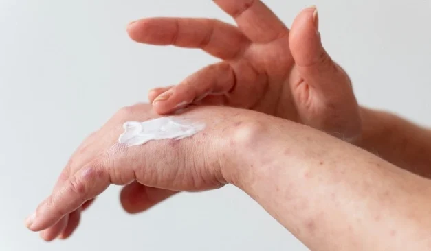 Percaya Diri Dengan Body Lotion: Solusi Alami Untuk Bekas Luka